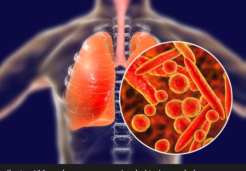 RSCM Harap Masyarakat Jangan Panik, Mycroplasma Pneumonia Tak Separah Covid-19