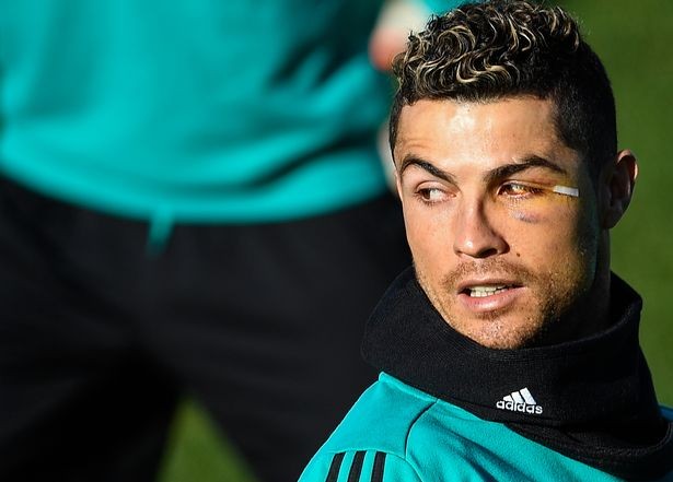 Mata Kirinya Lebam, Ronaldo Ngaku Masih Ganteng