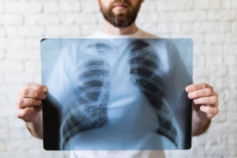 Ini Lima Cara Hindari Penyakit Tuberkulosis