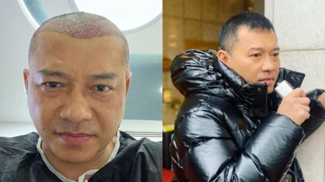 Anang Hermansyah Transplantasi Rambut di Turki, Ini Risiko dan Efek Sampingnya