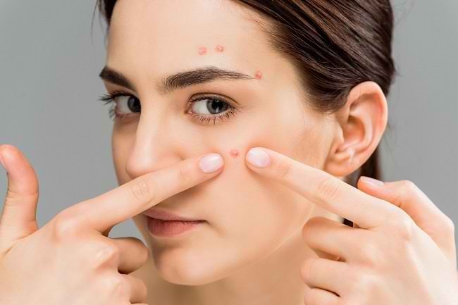 Berikut Tips Atasi Jerawat Secara Alami