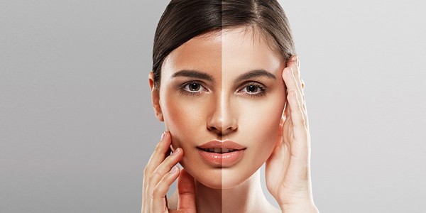 4 Tips Mengembalikan Kulit Belang Jadi Putih Secara Alami