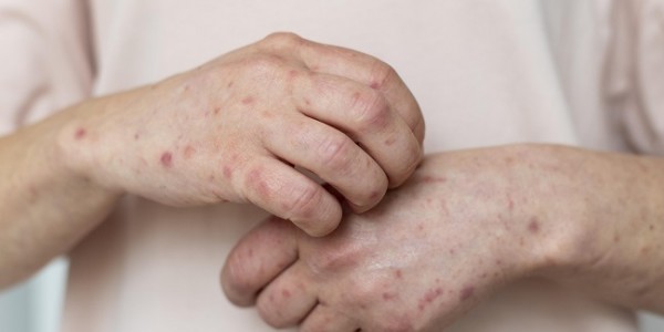 Waspada, Campak jadi Komplikasi Sebabkan Penyakit Berat